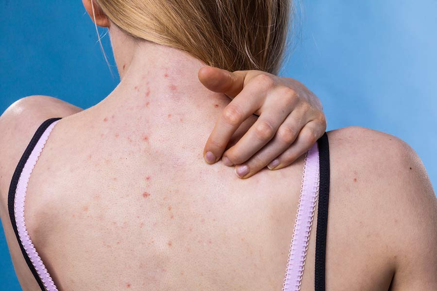 Salicylic Acid and Benzoyl Peroxide for Treating Acne - Lynn's Skin