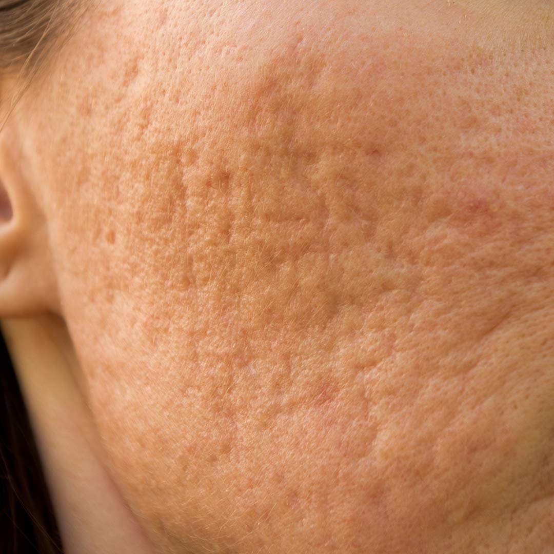 14 Week Series for Acne Scarring – a service offered at Lynn’s Skincare in Cottonwood AZ (near Sedona) 14 Week Series for Acne Scarring - a service offered at Lynn's Skincare in Cottonwood AZ (near Sedona)