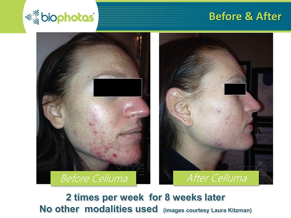 LED Light Therapy for Acne: Before & After