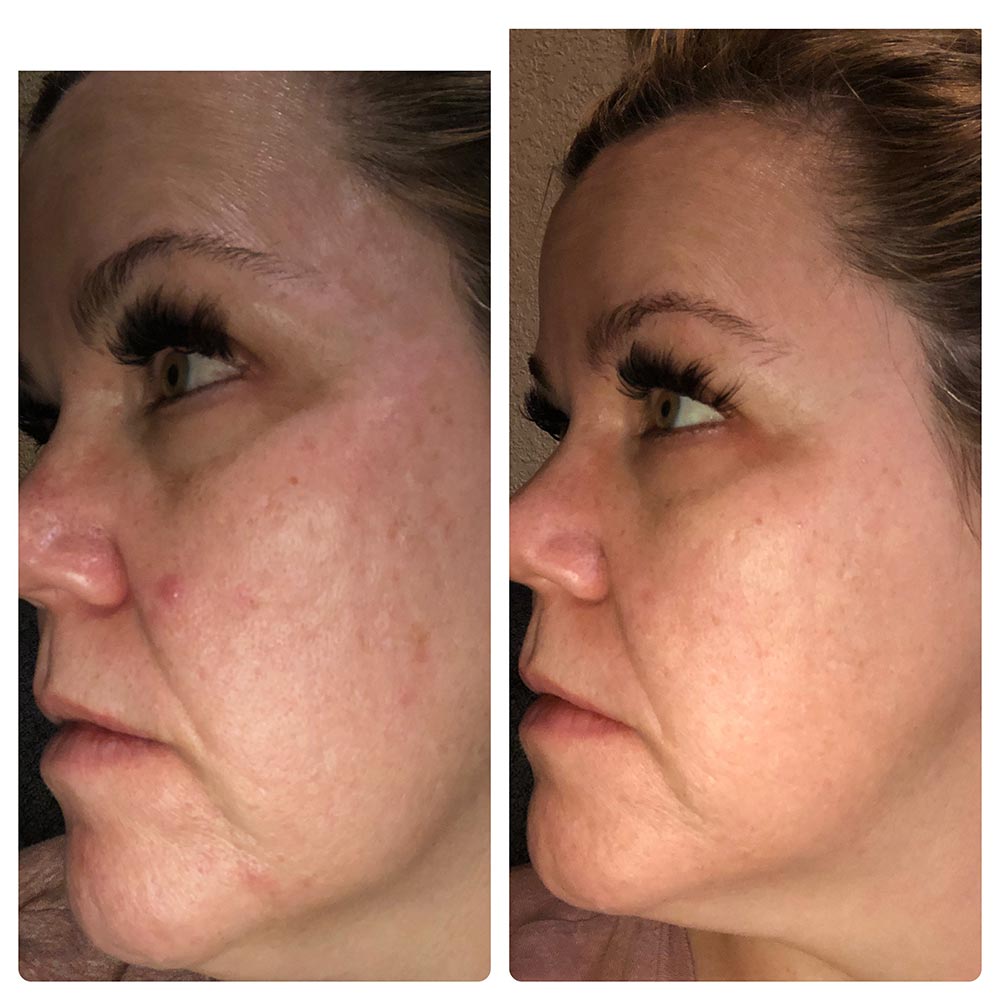 LED Light Therapy: Lynn's Before & After