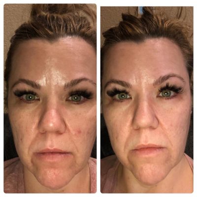 yellow led light therapy before and after