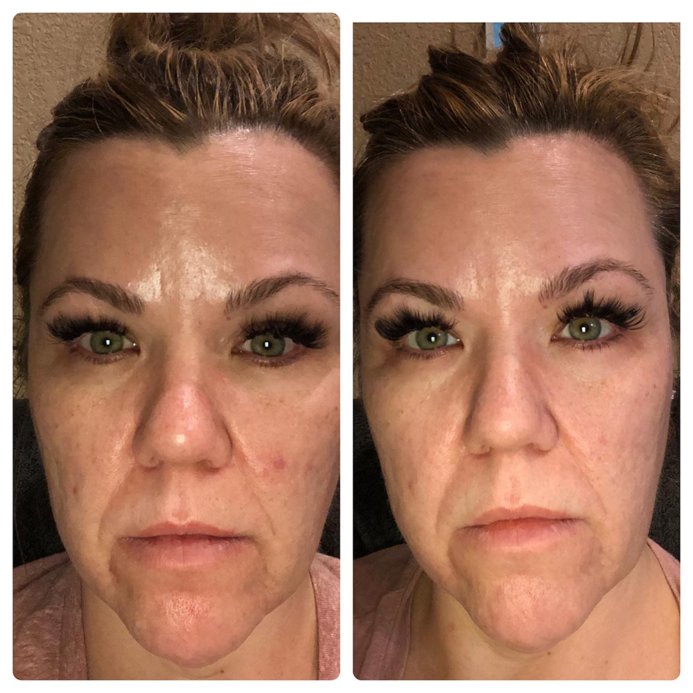 LED Light Therapy: Lynn's Before & After